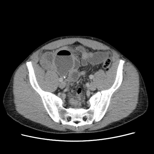 File:Appendicitis complicated by post-operative collection (Radiopaedia 35595-37114 A 67).jpg