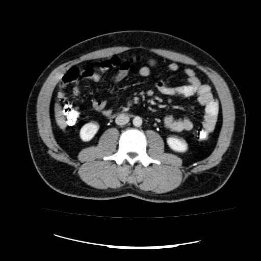 Appendicitis with diverticulosis (Radiopaedia 47693-52383 Axial C+ 69).jpg