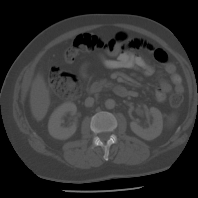Appendicitis with perforation (Radiopaedia 35790-37342 Axial bone window 22).jpg