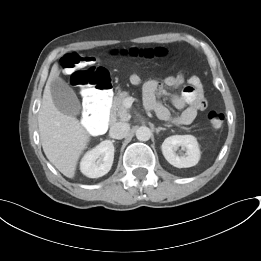 Appendicitis with thickening of the terminal ileum (Radiopaedia 42432-45550 A 33).png