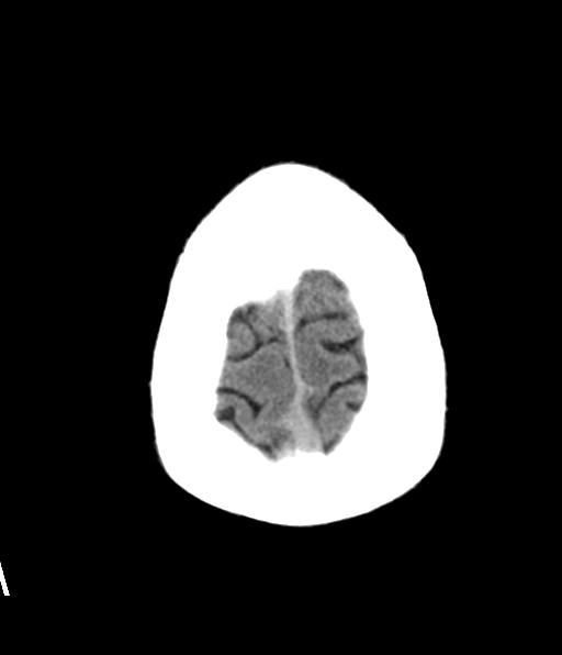 File:Aqueduct stenosis with corpus callosum hypoattenuation post shunting (Radiopaedia 37212-38973 Axial non-contrast 30).png