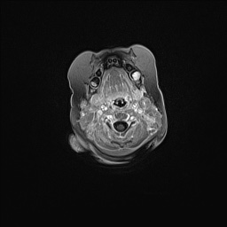 Aqueductal stenosis (Radiopaedia 73974-84802 Axial T1 C+ 20).jpg