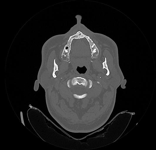 File:Arcuate foramen (Radiopaedia 89833-106944 Axial bone window 40).jpg