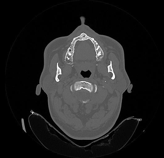 Arcuate foramen (Radiopaedia 89833-106944 Axial bone window 42).jpg