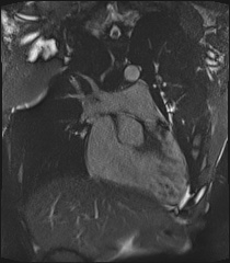 Arrhythmogenic right ventricular cardiomyopathy (Radiopaedia 57972-64966 CINE R2 SSFP 14).jpg