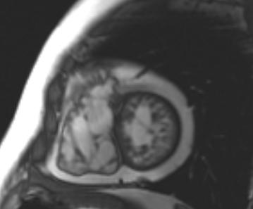 File:Arrhythmogenic right ventricular cardiomyopathy (Radiopaedia 69431-79307 Short axis cine 75).jpg