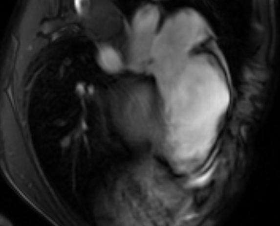 Arrhythmogenic right ventricular cardiomyopathy (Radiopaedia 69564-79464 4ch cine 107).jpg