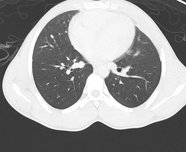 Arrow injury to the chest (Radiopaedia 75223-86321 Axial lung window 50).jpg