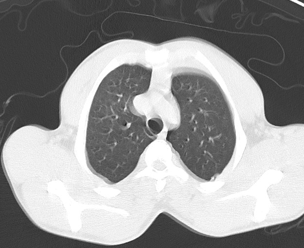 Arrow injury to the chest (Radiopaedia 75223-86321 Axial lung window 7).jpg