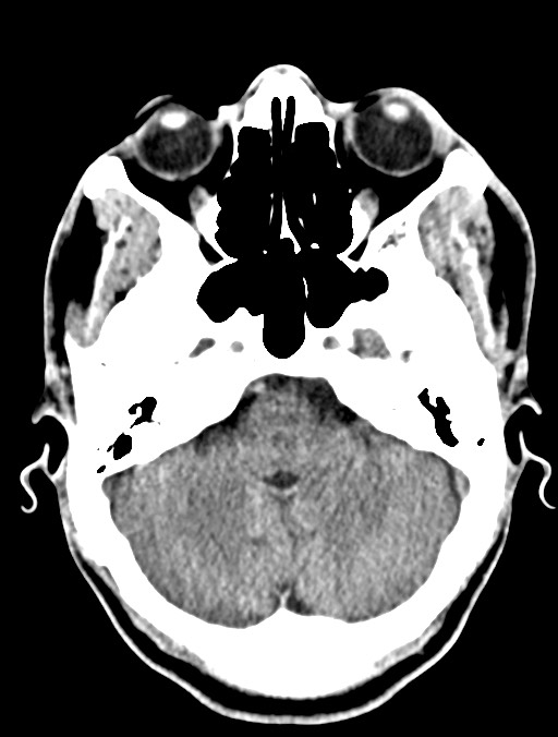 Arrow injury to the head (Radiopaedia 75266-86388 Axial non-contrast 11).jpg