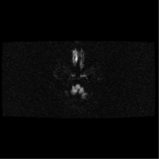 File:Arteriovenous malformation (cerebral) (Radiopaedia 40070-42580 Axial DWI 3).png