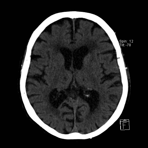 File:Artery of Percheron infarction (Radiopaedia 26307-26439 Axial non-contrast 23).jpg