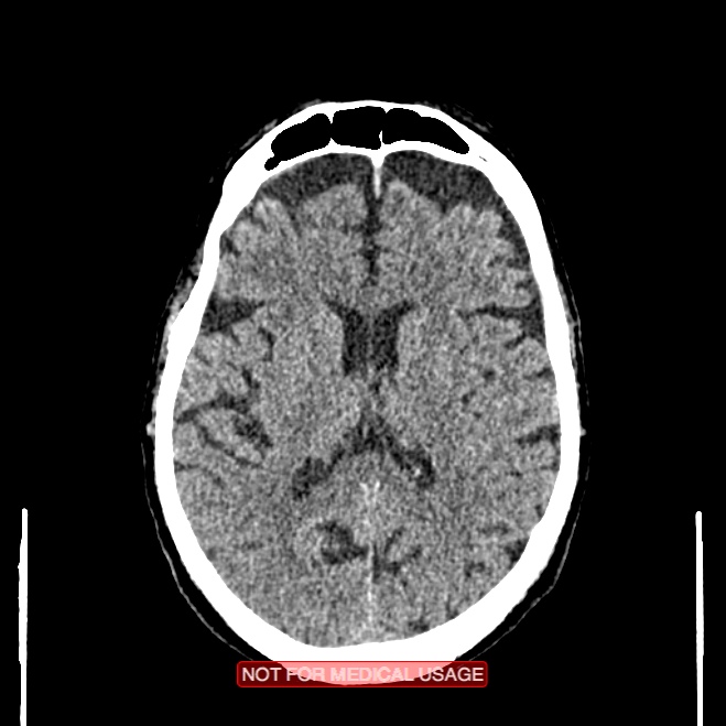 Artery of Percheron infarction (Radiopaedia 28679-28967 Axial non-contrast 68).jpg