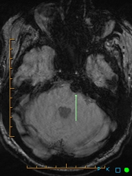 File:Artifactual basilar artery stenosis due to metallic stent (Radiopaedia 31206-31922 Axial SWI 1).jpg