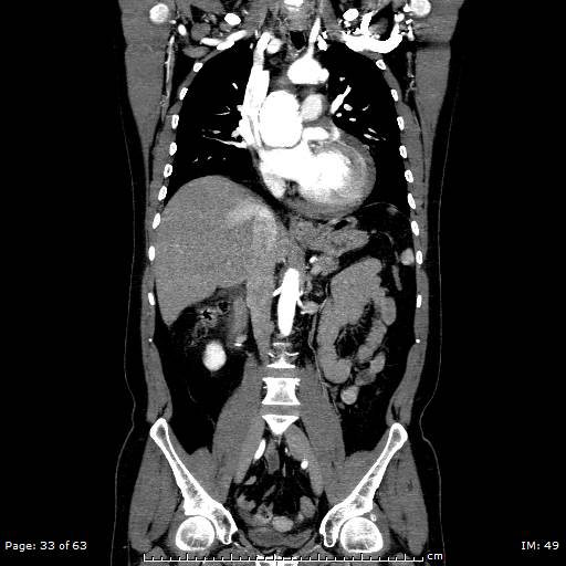 Ascending aortic aneurysm (Radiopaedia 50086-55404 B 33).jpg