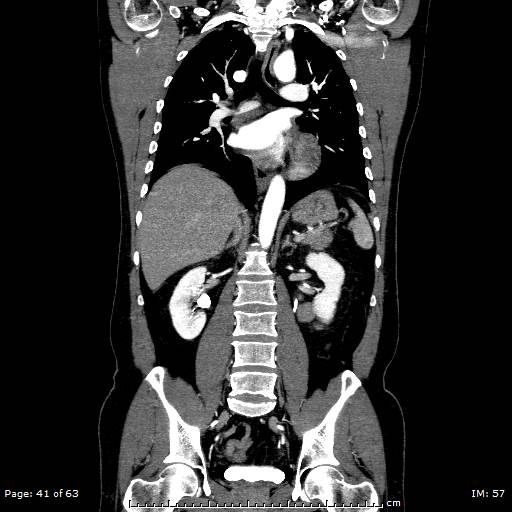Ascending aortic aneurysm (Radiopaedia 50086-55404 B 41).jpg