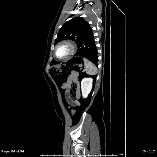 Ascending aortic aneurysm (Radiopaedia 50086-55404 C 60).jpg