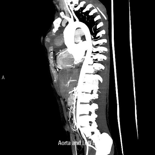 File:Ascending aortic pseudoaneurysm (Radiopaedia 28638-28910 C 1).jpg
