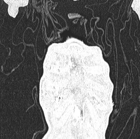 File:Aspergilloma- with Monod sign (Radiopaedia 44737-48532 Coronal lung window 119).jpg