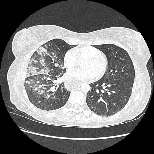 Aspiration pneumonia secondary to laparoscopic banding (Radiopaedia 18345-18183 lung window 65).jpg