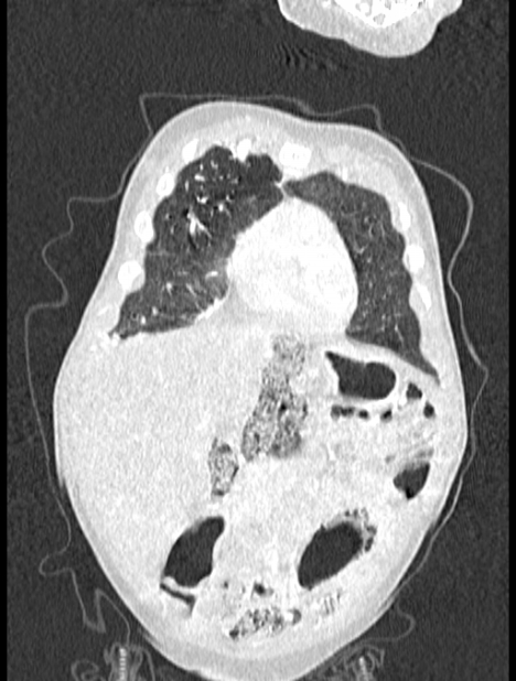 Asplenia syndrome (Radiopaedia 73083-83792 Coronal lung window 19).jpg