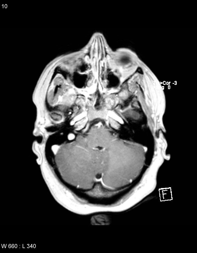Astroblastoma (Radiopaedia 39792-42218 Axial T1 C+ 9).jpg