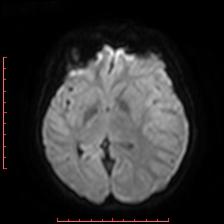 Astroblastoma (Radiopaedia 74287-85162 Axial DWI 50).jpg