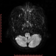 Astroblastoma (Radiopaedia 74287-85162 Axial DWI 8).jpg
