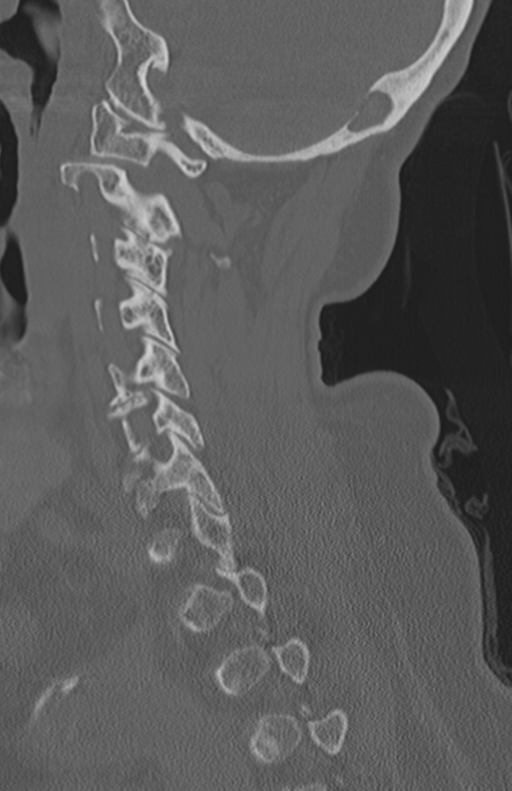 Atlanto-axial subluxation (Radiopaedia 36610-38176 Sagittal bone window 32).png