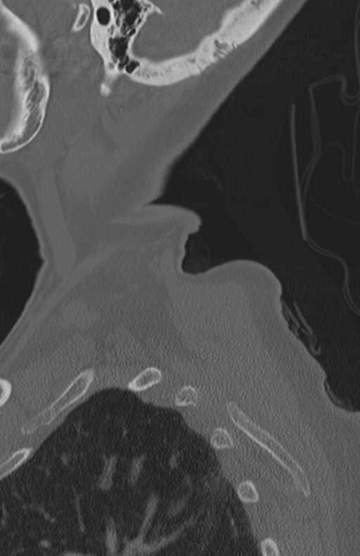 Atlanto-axial subluxation (Radiopaedia 36610-38176 Sagittal bone window 8).png
