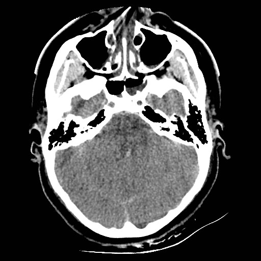 File:Atlanto-occipital dislocation (Radiopaedia 44648-48412 Axial non-contrast 17).jpg