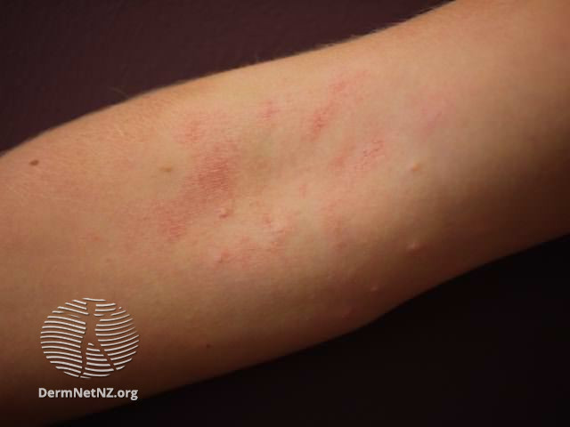 File:Atopic dermatitis (DermNet NZ dermatitis-flexural-eczema04).jpg