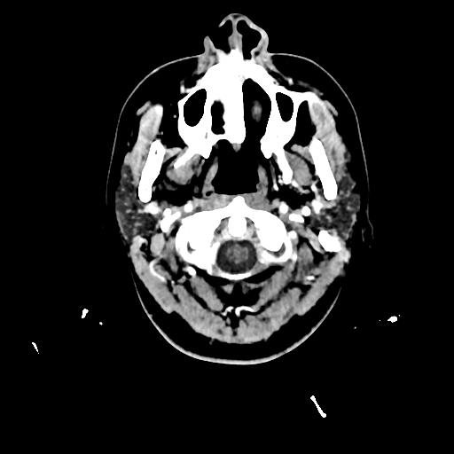 Atretic cephalocele (Radiopaedia 89782-106881 Axial with contrast 8).jpg