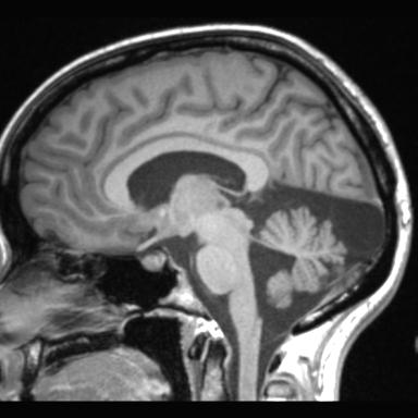 Atretic encephalocoele with inferior vermis hypoplasia (Radiopaedia 30443-31108 Sagittal T1 69).jpg