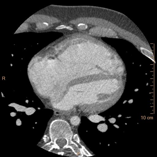 Atrial septal defect (upper sinus venosus type) with partial anomalous pulmonary venous return into superior vena cava (Radiopaedia 73228-83961 A 160).jpg