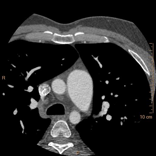 Atrial septal defect (upper sinus venosus type) with partial anomalous pulmonary venous return into superior vena cava (Radiopaedia 73228-83961 A 27).jpg