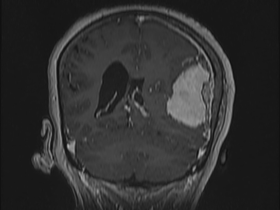 Atypical meningioma (Radiopaedia 62985-71406 Coronal T1 C+ 86).jpg