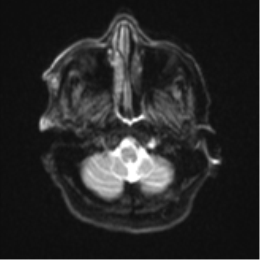 Atypical meningioma (WHO Grade II) (Radiopaedia 54742-60981 Axial DWI 4).png
