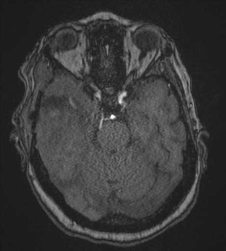 Atypical meningioma (WHO Grade II) (Radiopaedia 54742-60981 Axial MRA 34).png