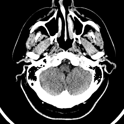 Atypical meningioma (WHO grade II) with brain invasion (Radiopaedia 57767-64728 Axial C+ 48).png