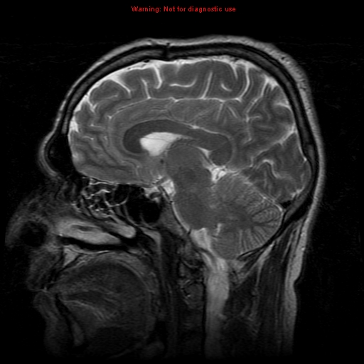 File:Atypical meningioma - grade II (Radiopaedia 13303-13305 Sagittal T2 13).jpg