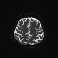 Autoimmune limbic encephalitis (Radiopaedia 30363-31005 Axial B0 and DWI 26).jpg