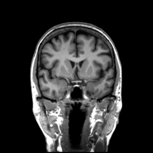 Autoimmune limbic encephalitis (Radiopaedia 30363-31005 Coronal T1 36).jpg
