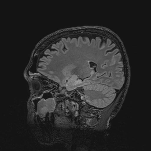Autoimmune limbic encephalitis (Radiopaedia 30363-31005 Sagittal FLAIR 101).jpg