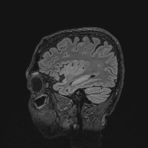 Autoimmune limbic encephalitis (Radiopaedia 30363-31005 Sagittal FLAIR 47).jpg