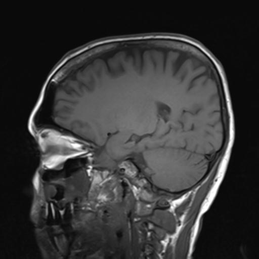 File:Autoimmune limbic encephalitis (Radiopaedia 30363-31005 Sagittal T1 9).jpg