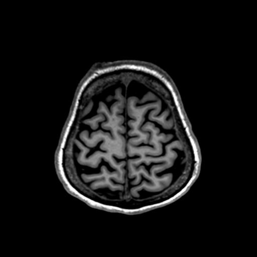 Autoimmune limbic encephalitis (Radiopaedia 30363-31005 T1 Axial 1mm 128).jpg