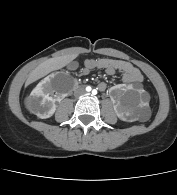 Autosomal dominant polycystic kidney disease - early onset (Radiopaedia 40734-43387 B 40).jpg