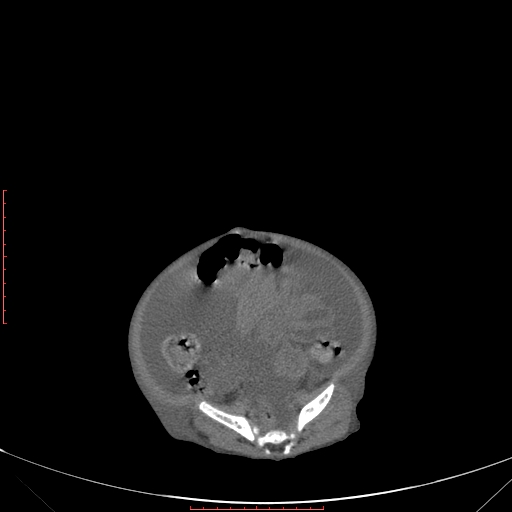 Autosomal recessive polycystic kidney disease associated with Caroli disease (Radiopaedia 61932-69984 B 297).jpg