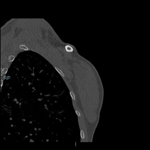 Avascular necrosis after fracture dislocations of the proximal humerus (Radiopaedia 88078-104655 Coronal bone window 134).jpg